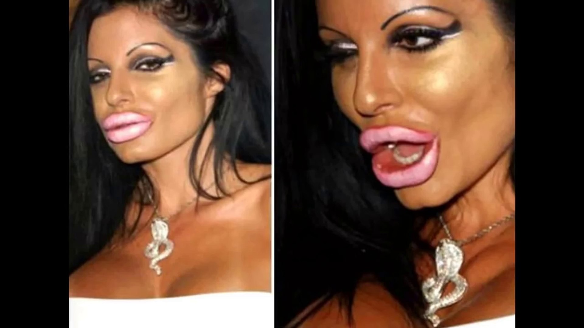 Les Pires Rates De La Chirurgie Esthetique