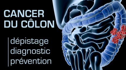 Cancer du côlon : dépistage, diagnostic et prévention
