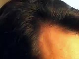 HAIR TRANSPLANT HAIR RESTORATION DALLAS CLOSEUP 2
