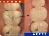 Natural One-Visit Porcelain Crowns and Veneers with CEREC 3D