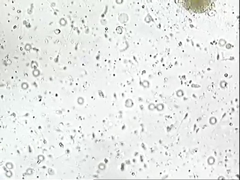 Abstructive Azoospermia - PESA- Chennai Fertility Center -Dr.VM.Thomas