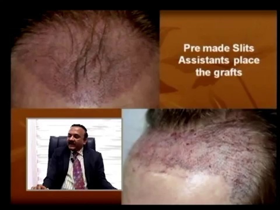 Pre Made Slits For Hair Transplantation - Hair Loss Solutions for both Men & Women