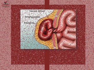 Get hernia surgery in Varanasi to overcome hernia