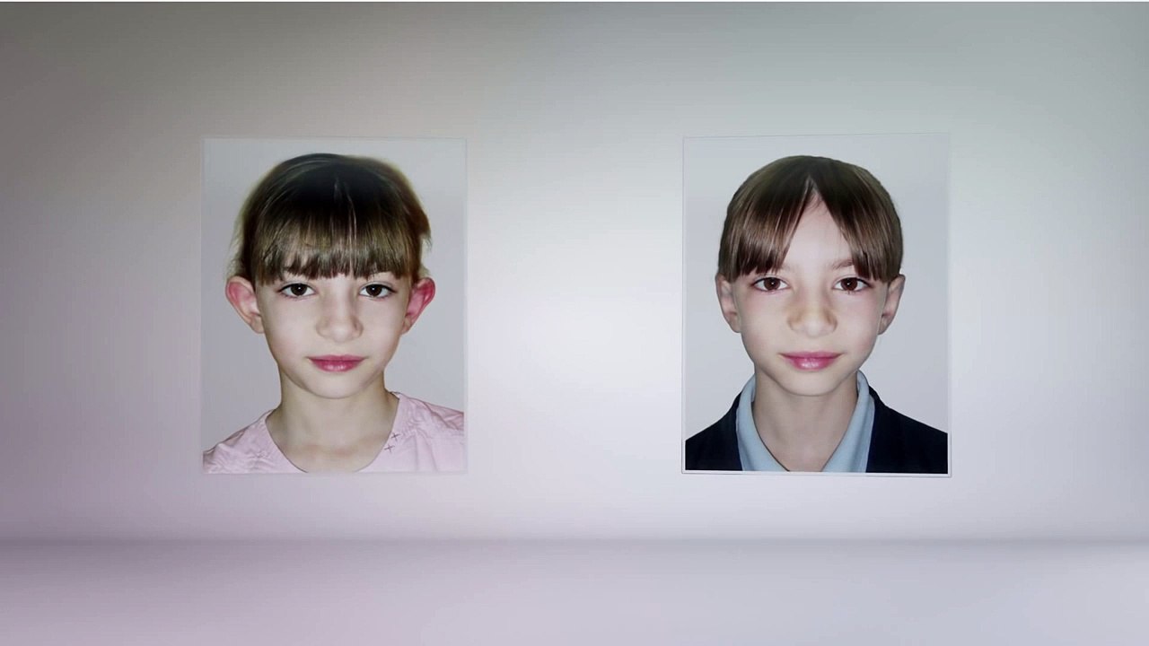 Oreilles décollées : Une nouvelle technique change la forme des oreilles en quelques minutes