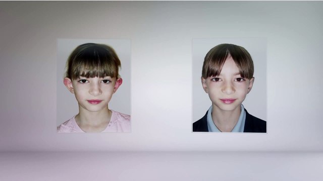 Oreilles décollées : Une nouvelle technique change la forme des oreilles en quelques minutes