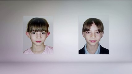 Oreilles décollées : Une nouvelle technique change la forme des oreilles en quelques minutes