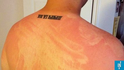 Photos des pires traces de bronzages