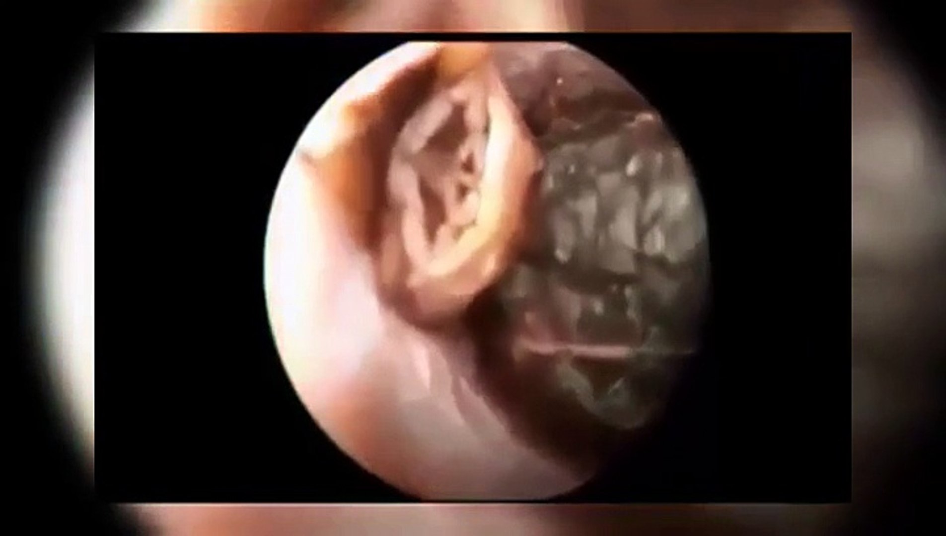 Un gros insecte coincé dans l'oreille - Vidéo Dailymotion