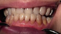 Emdogain Surgical Revision of Previous Alloderm Gingival Grafting Surgery, #25-20
