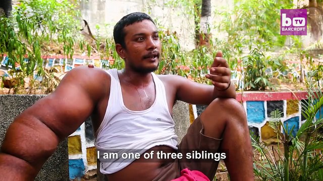 Atteint de Gigantisme, son bras pèse 20kg