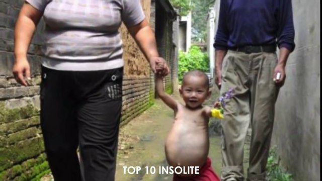 10 Personnes avec des MUTATIONS GENETIQUES EXTRAORDINAIRE ! Incroyables Mutations Très RARE