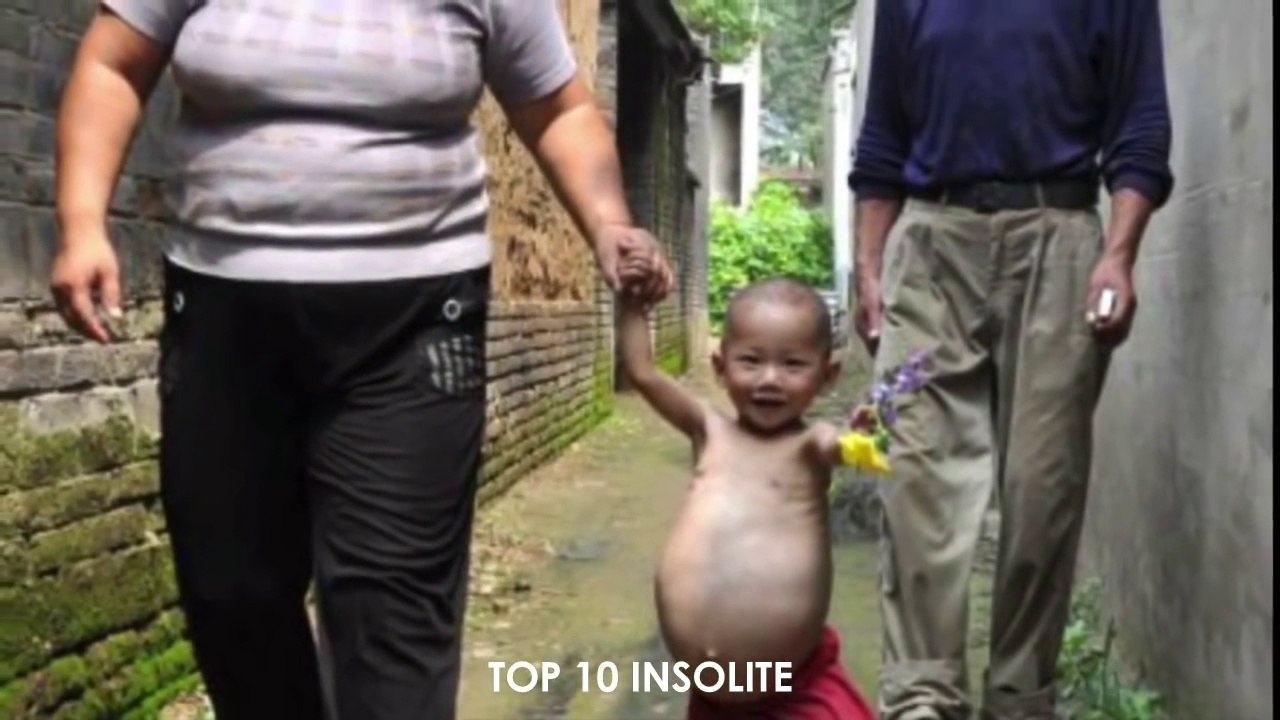 10 Personnes avec des MUTATIONS GENETIQUES EXTRAORDINAIRE ! Incroyables Mutations Très RARE