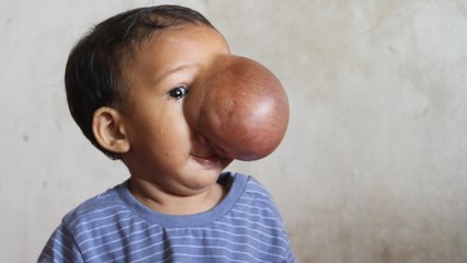 Social Media Secures Life Changing Surgery For Brain Tumour Toddler