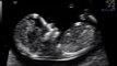 15 Weeks Doppler Foetal Heart Beat (audio only)