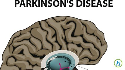 Treatment For Parkinson's Disease Found in biomarker in Urine Samples
