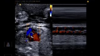 Ecocardiografia colorida 25 semanas