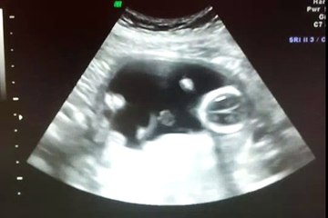 15 Week Ultrasound -Baby Gender Reveal!