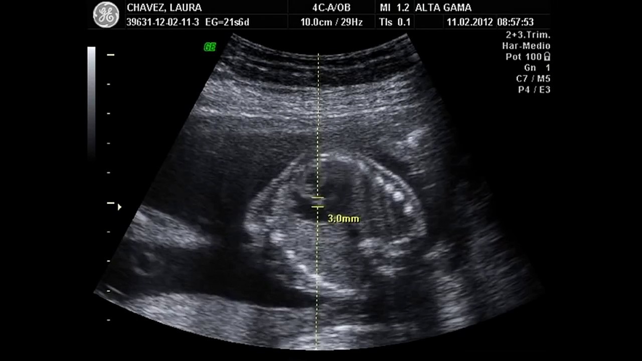 Ecografía Obstétrica de 22 semanas 2 (Giovanni Rossetto)