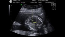 Ecografía Obstétrica de 22 semanas 2 (Giovanni Rossetto)