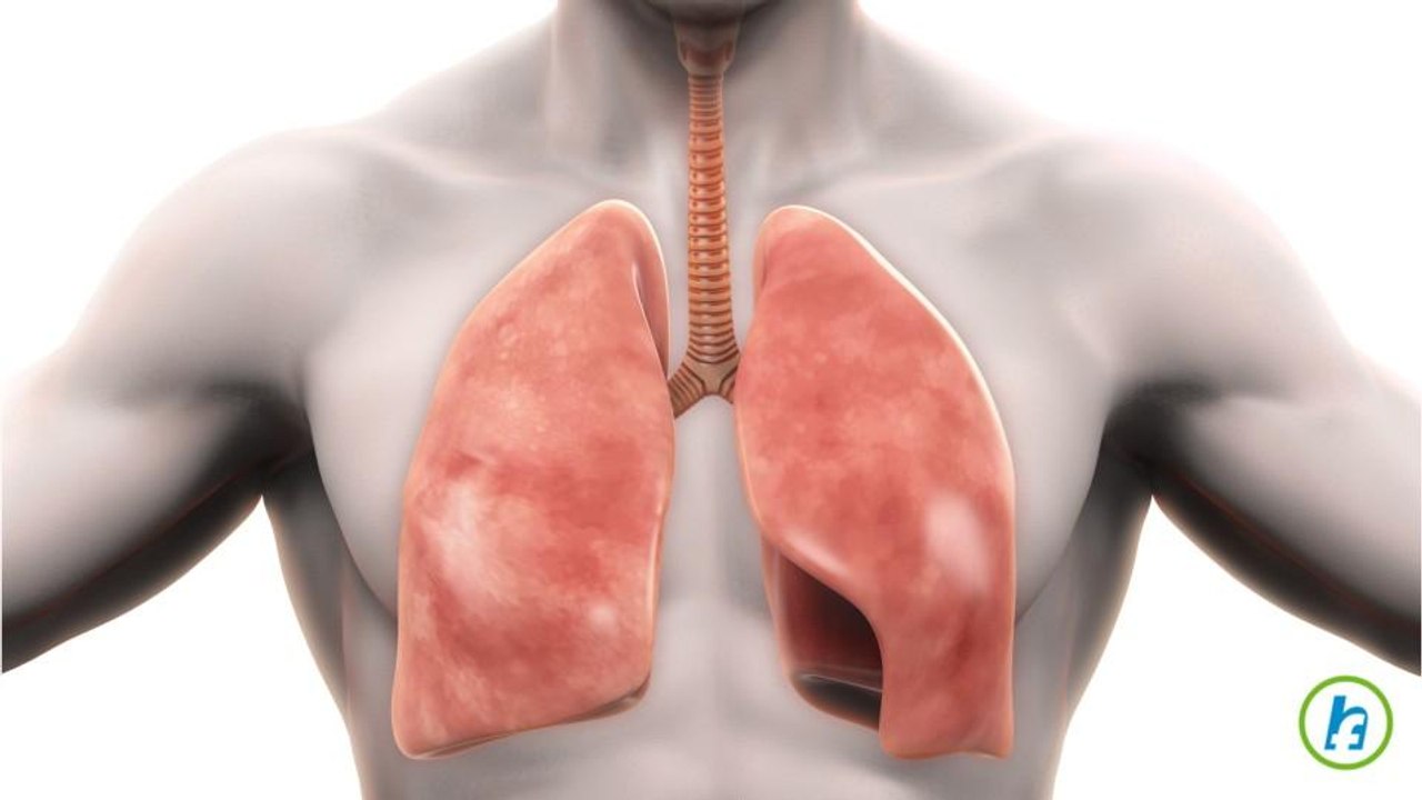 What is atelectasis?