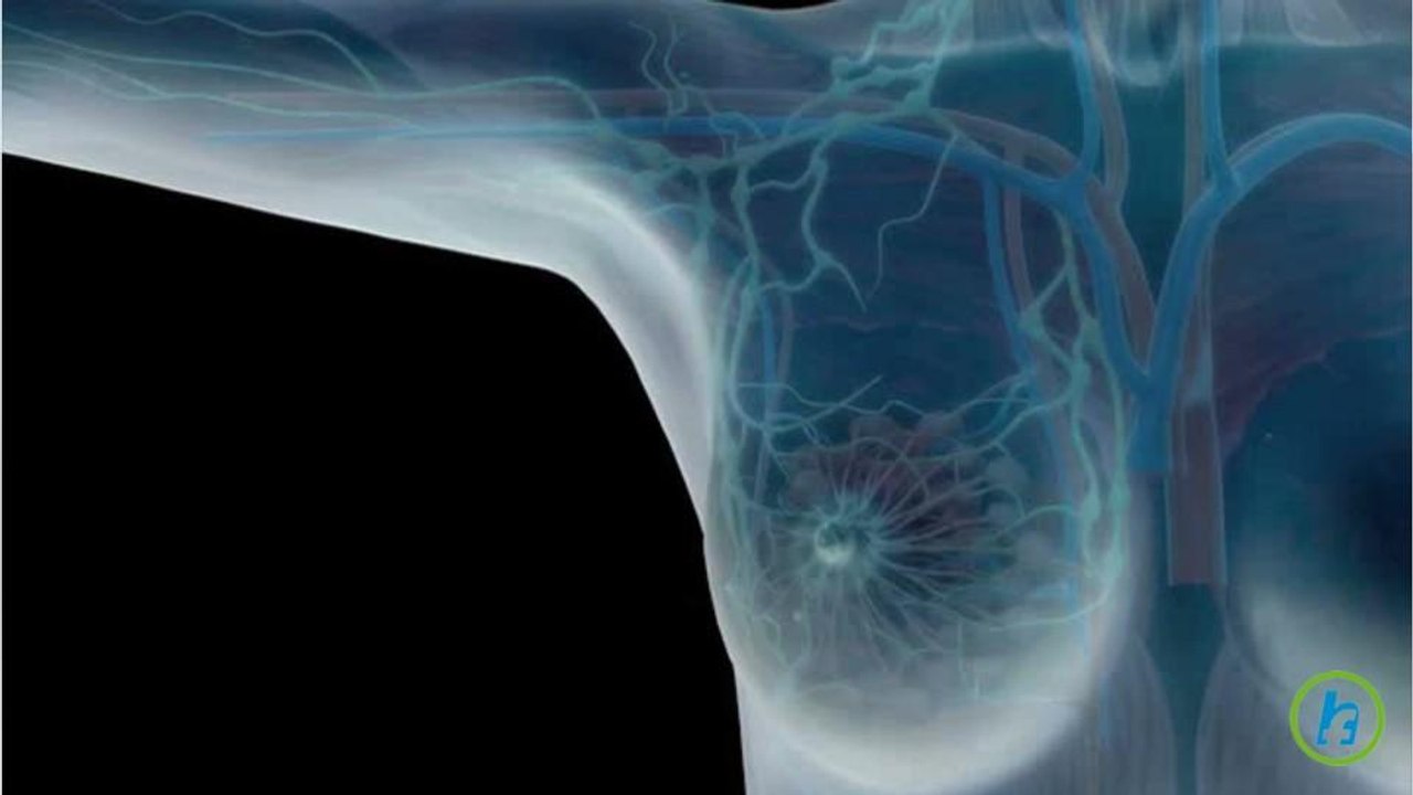 Better Outcomes from Breast Cancer Treatment Linked to Gene Mutations in Patients