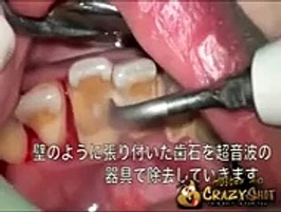 Quand vous restez un moment sans vous brosser les dents voici les résultats