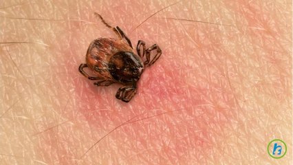 Risks of Tick Bites