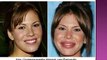 27- Plastic Surgery Fail (before after) 27 - Cirurgia Plastica - Antes Despues - youtube
