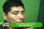 acne rosacea cura total medicina natural plantas medicinales uriel tapia 19