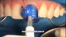 Kırık Diş Nasıl Tedavi Edilir ?