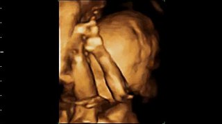 3D Ultrasound (20 Weeks Pregnant)