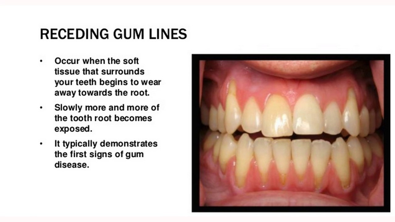 How To Reverse Receding Gums Naturally?