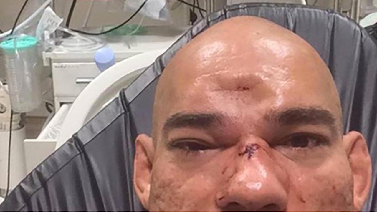 Evangelista 'Cyborg' Santos Has Gruesome Dent In His Head After Bellator Fight