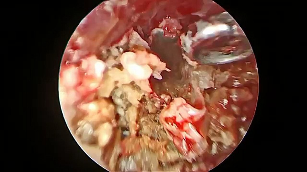 Extraction d'un énorme bouchon de cérumen