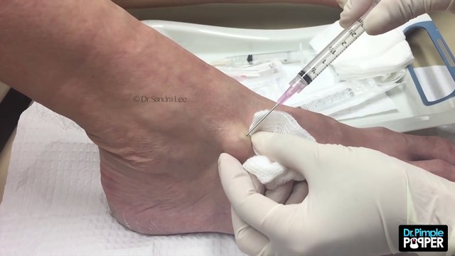 Excision Of A Bump On Right Foot!