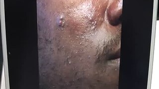 The Acne Practice  (African American 1)