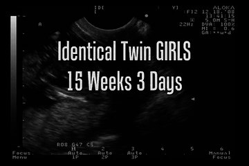 Twin Gender Ultrasound - Girls! 15 weeks 3 days