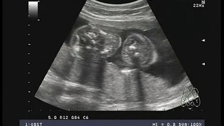 conjoined twins ultrasound 20 weeks