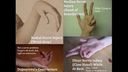 USMLE: Few Selected Upper Limb Nerve Injuries