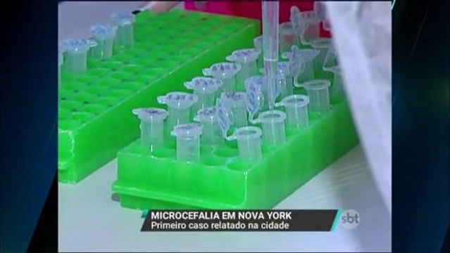 Nova York registra o primeiro caso de microcefalia relacionada ao zika vírus