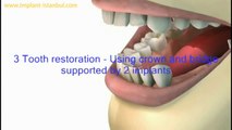 3 diş boşluğuna 2 implant üzeri 3 porselen diş yapımı süreci