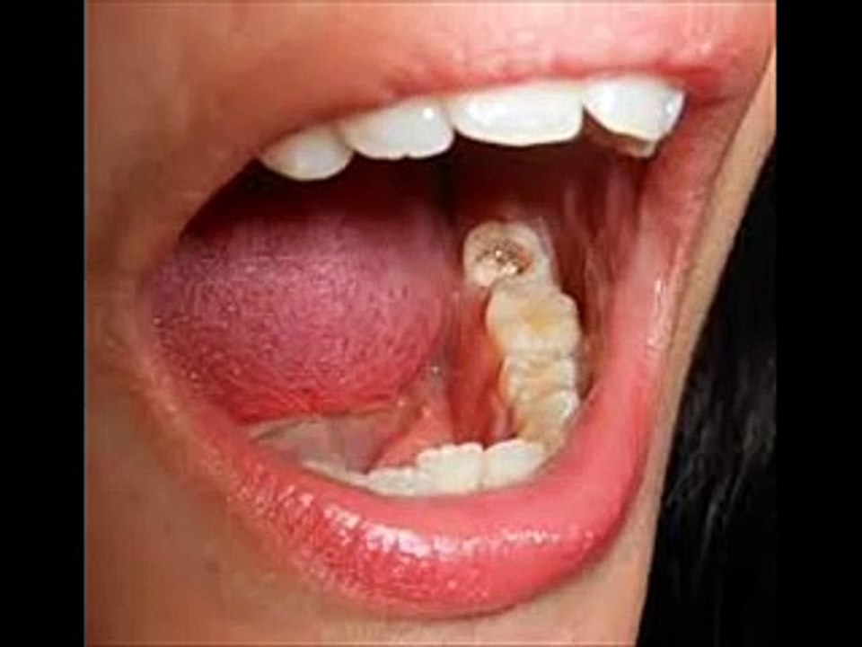 10 Cara Mengobati Sakit Gigi Berlubang Secara Alami