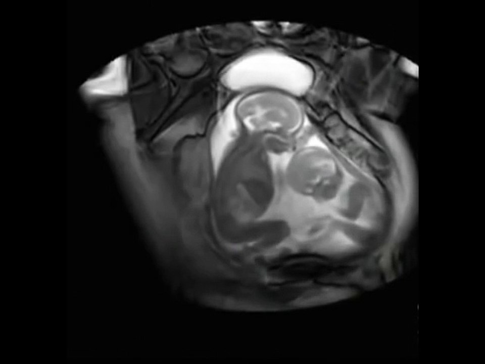 Twins Fighting Inside Womb; AMAZING