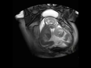 Twins Fighting Inside Womb; AMAZING