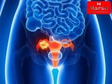 Signs and symptoms of ovarian cancer