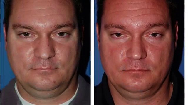 (206) 624-6200 Top Surgeon For Revision Rhinoplasty Surgery Seattle Washington
