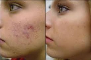 Acne Signs and symptoms