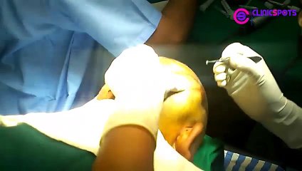 Hair Transplant in Delhi, India - Review & Procedure - Best Hair Transplant in India