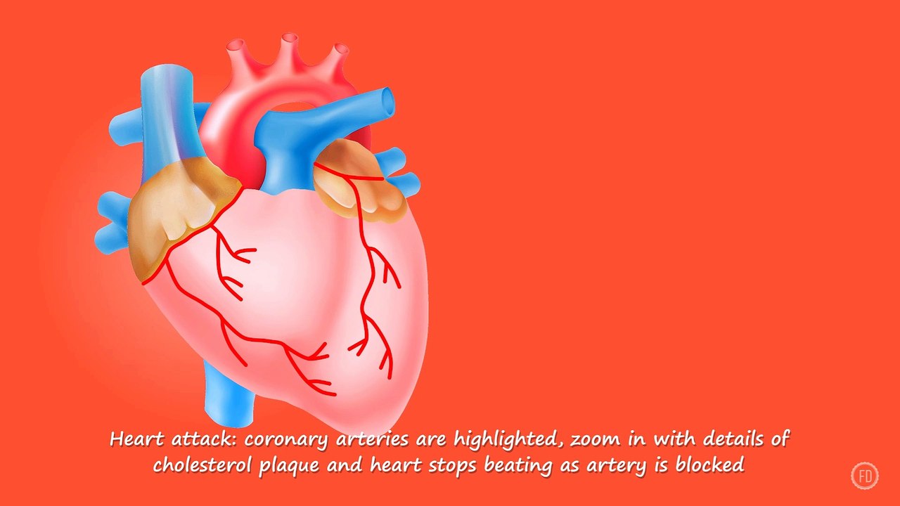 Process of Heart Attack | Medical Education | HD Video | F1 Digitals