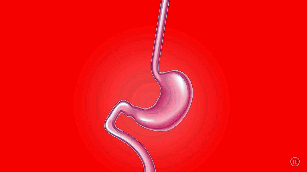 Roux-en-Y Gastric Bypass | Medical Education | HD Video | F1 Digitals